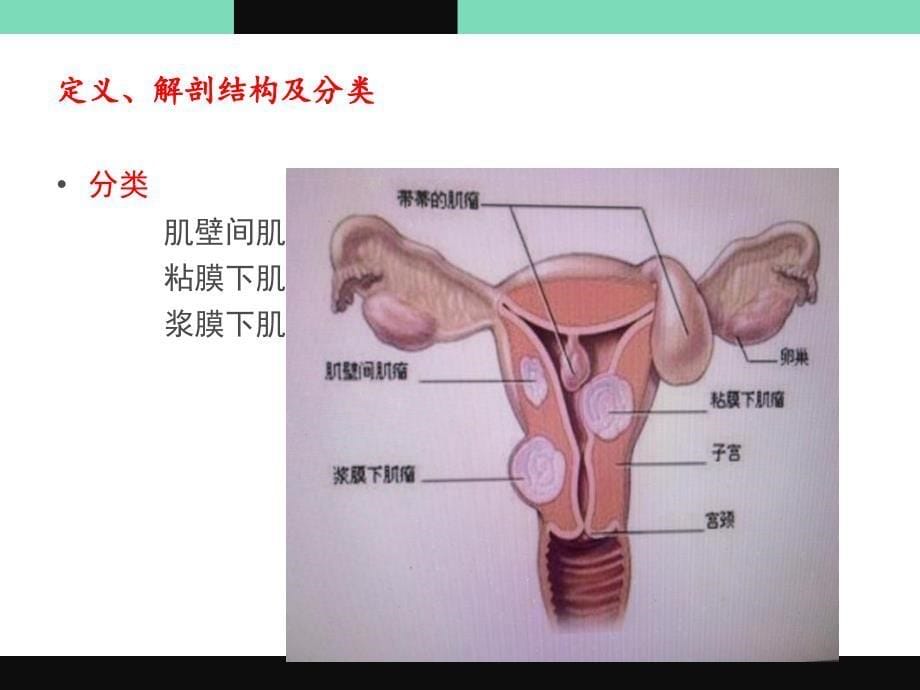 经腹子宫肌瘤剔除术课件_第5页