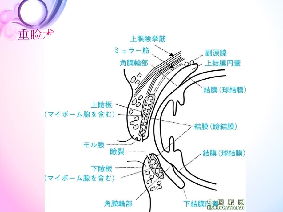 不开刀变双眼皮的方式.ppt_第2页