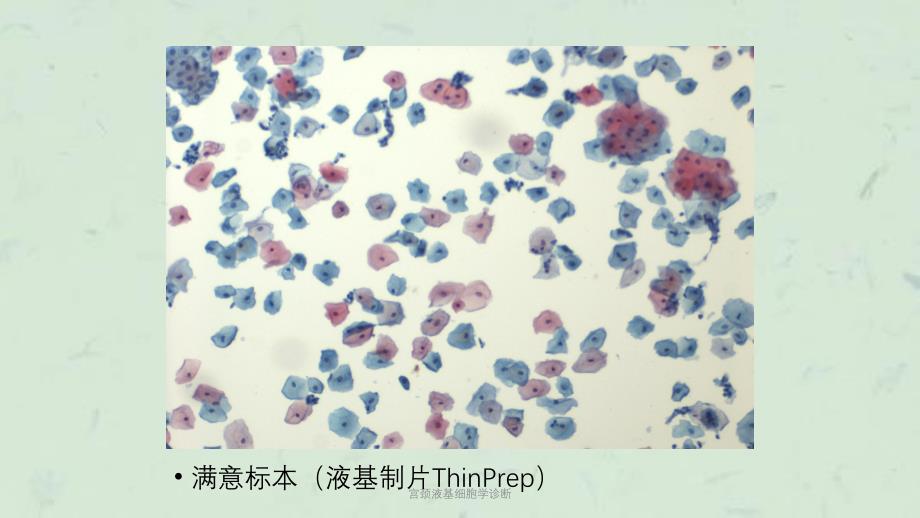 宫颈液基细胞学诊断课件_第4页