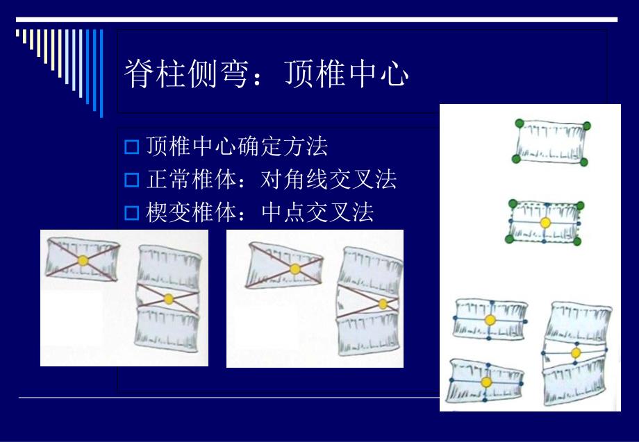 脊柱侧弯基础知识文档资料_第3页