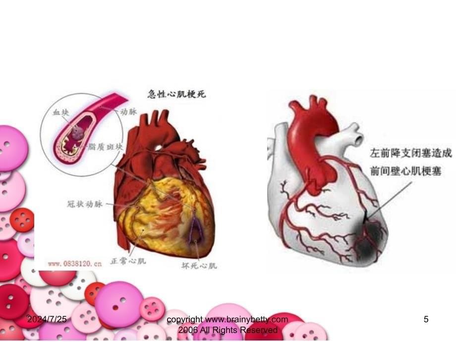 急性心肌梗死病人的护理文档资料_第5页