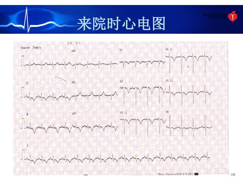 活动后喘憋呼吸困难(急性肺栓塞)_第4页