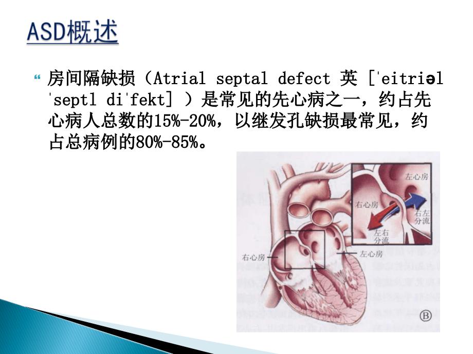 房间隔缺损封堵术的护理_第3页