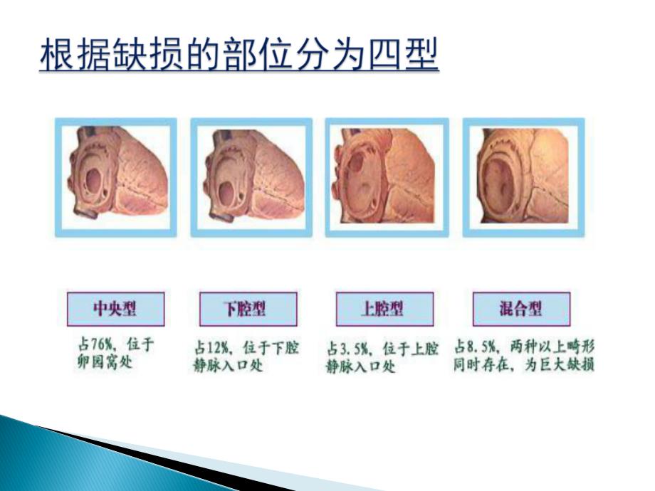 房间隔缺损封堵术的护理_第4页