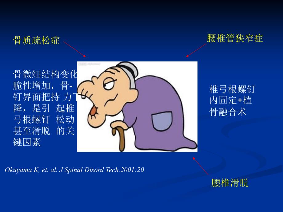 腰椎滑脱伴骨质疏松的手术治疗_第4页