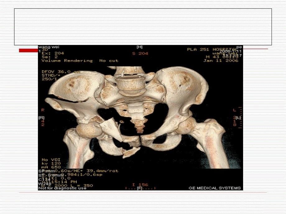 新骨盆骨折课件_第5页