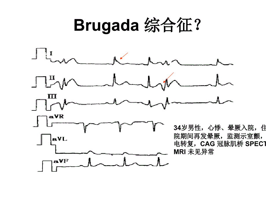 J波与J波综合征ppt课件_第2页