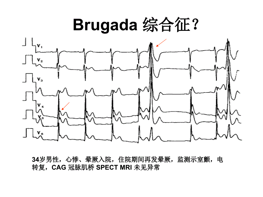 J波与J波综合征ppt课件_第3页