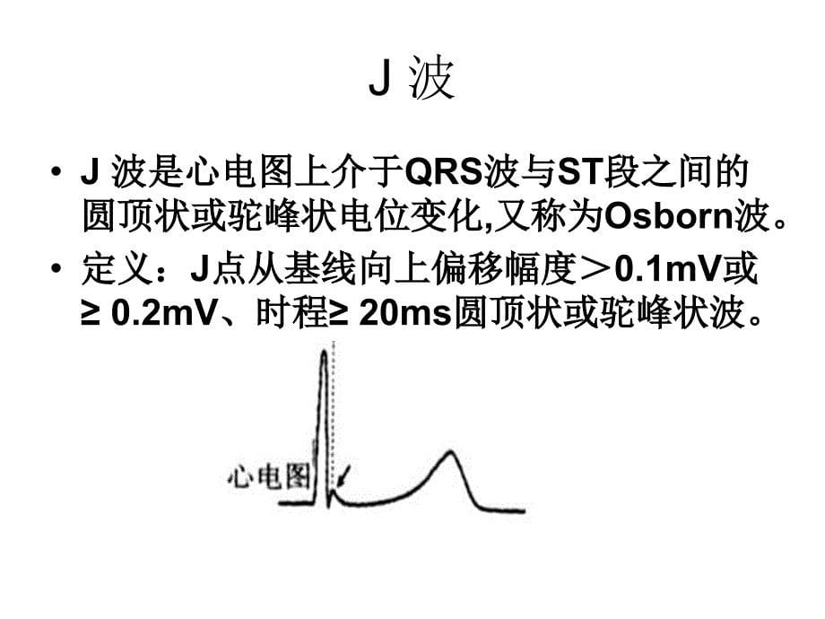 J波与J波综合征ppt课件_第5页