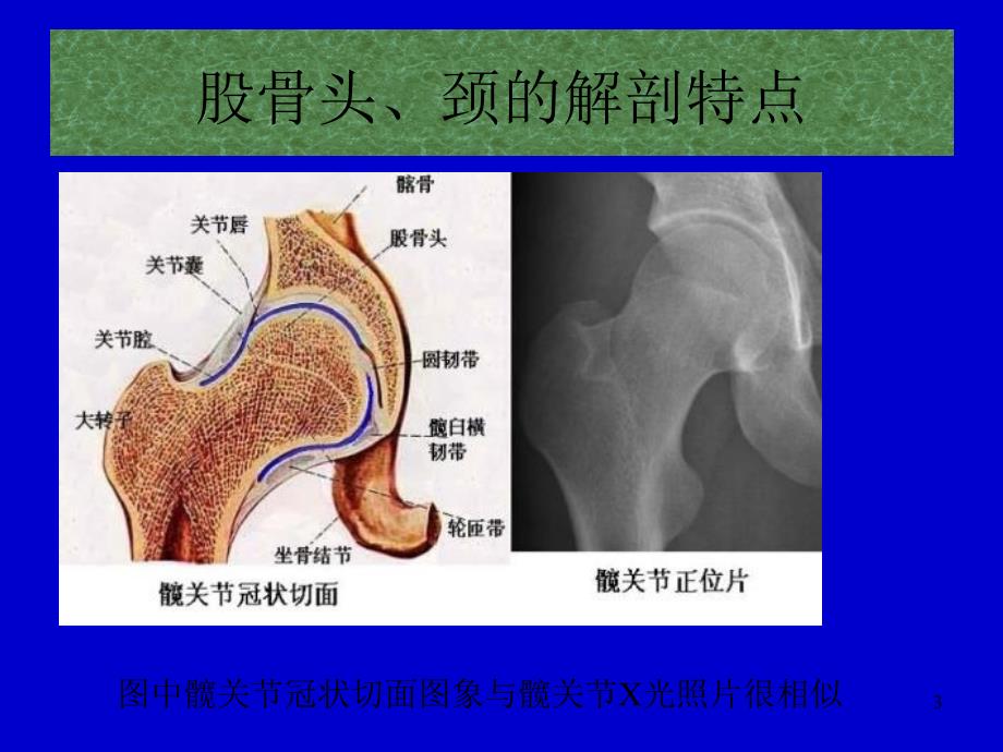 推荐精选编辑股骨头缺血坏死影像学诊断_第3页