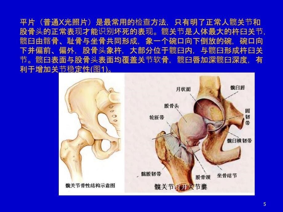 推荐精选编辑股骨头缺血坏死影像学诊断_第5页