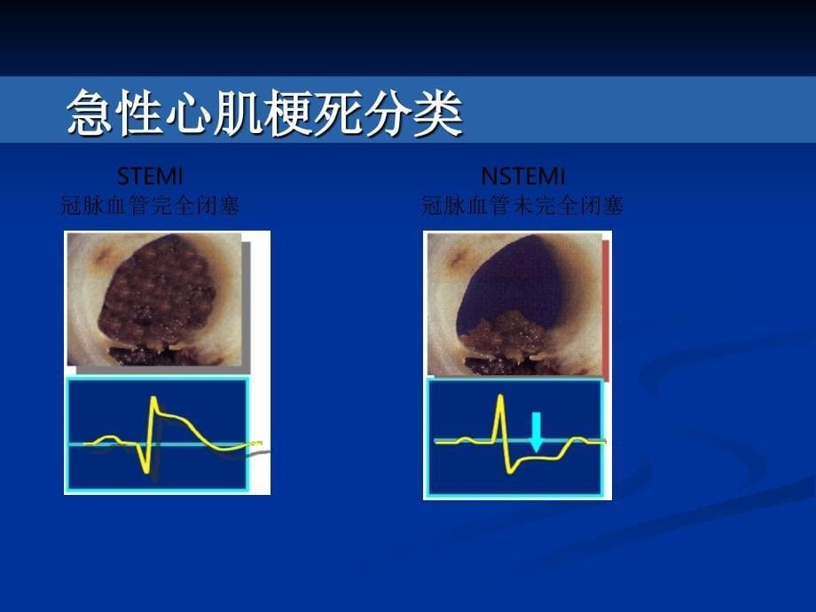 STEMI患者的诊断与鉴别诊断_第5页