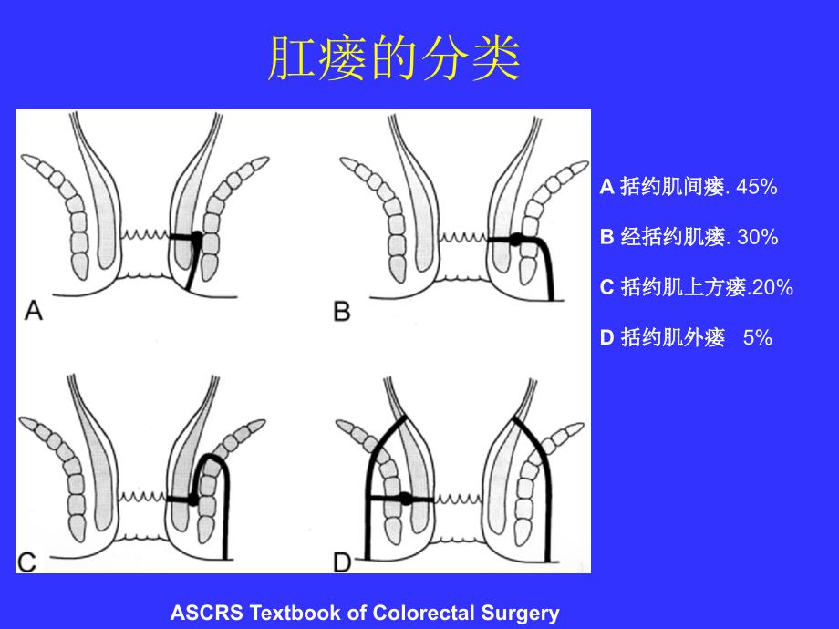 肛瘘病因和保留括约肌手术.ppt_第4页