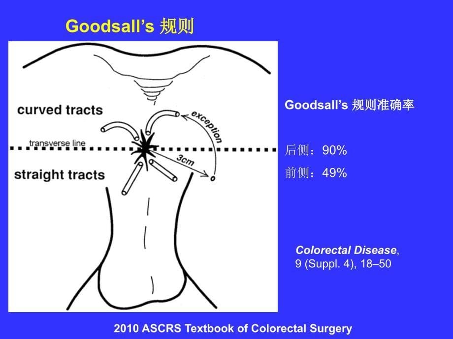 肛瘘病因和保留括约肌手术.ppt_第5页