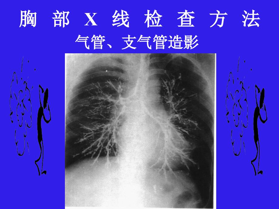 医学教学课件：呼吸系统影像诊断学_第4页