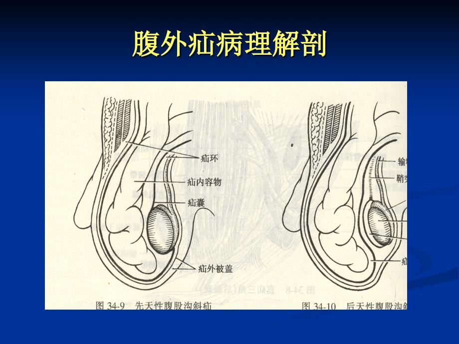 《腹外疝的护理》PPT课件_第4页