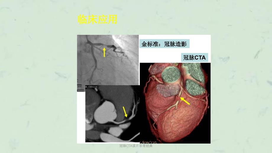 冠脉CTA读片非常经典课件_第2页