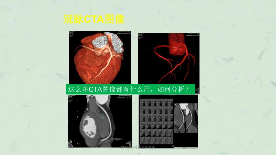 冠脉CTA读片非常经典课件_第3页