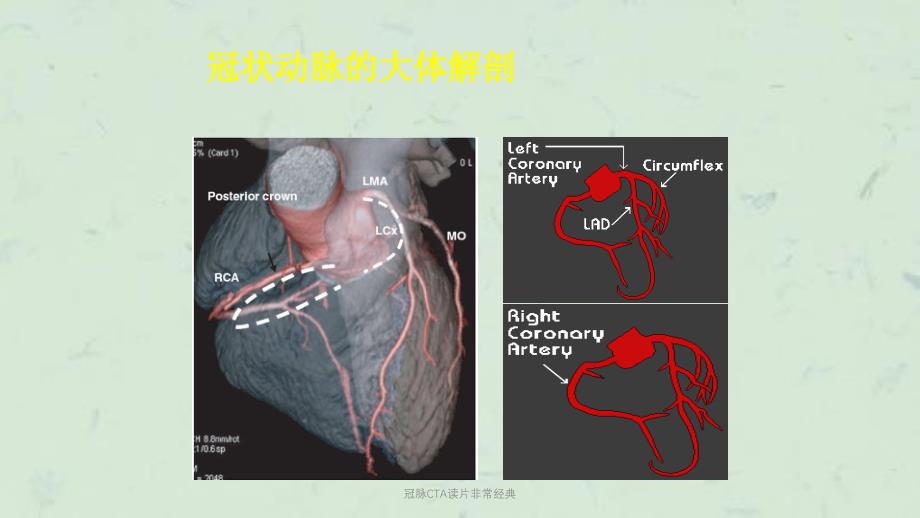 冠脉CTA读片非常经典课件_第4页