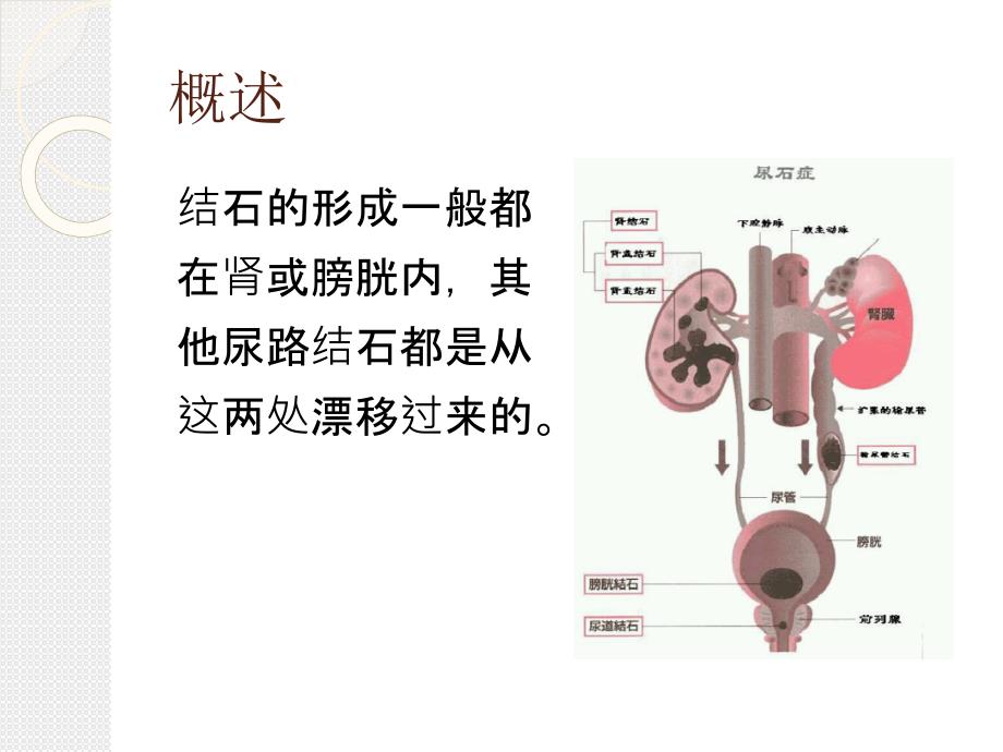 《泌尿系统结石》PPT课件.ppt_第4页