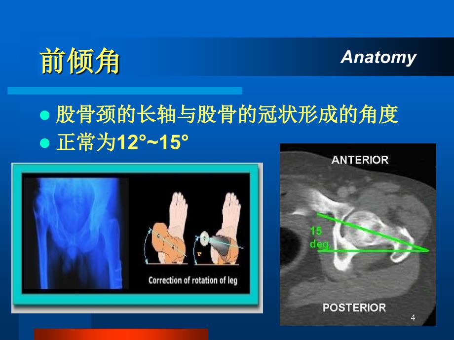 股骨颈骨折课件_第4页