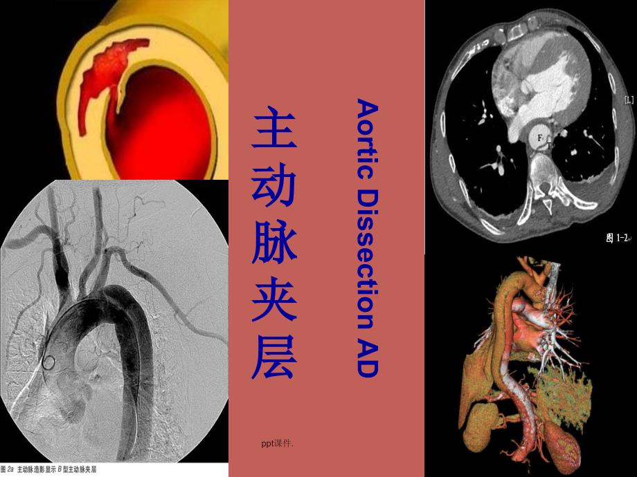 外科学主动脉夹层与周围血管病精选幻灯片_第2页