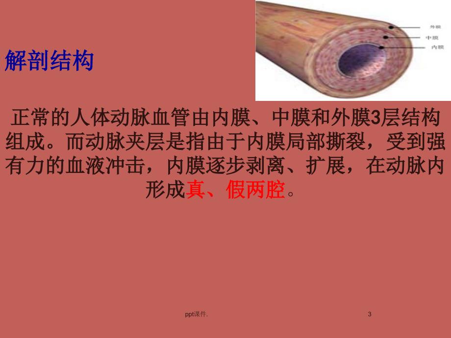 外科学主动脉夹层与周围血管病精选幻灯片_第3页