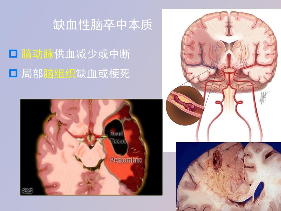 急性脑梗塞血管再通流程优化_第4页