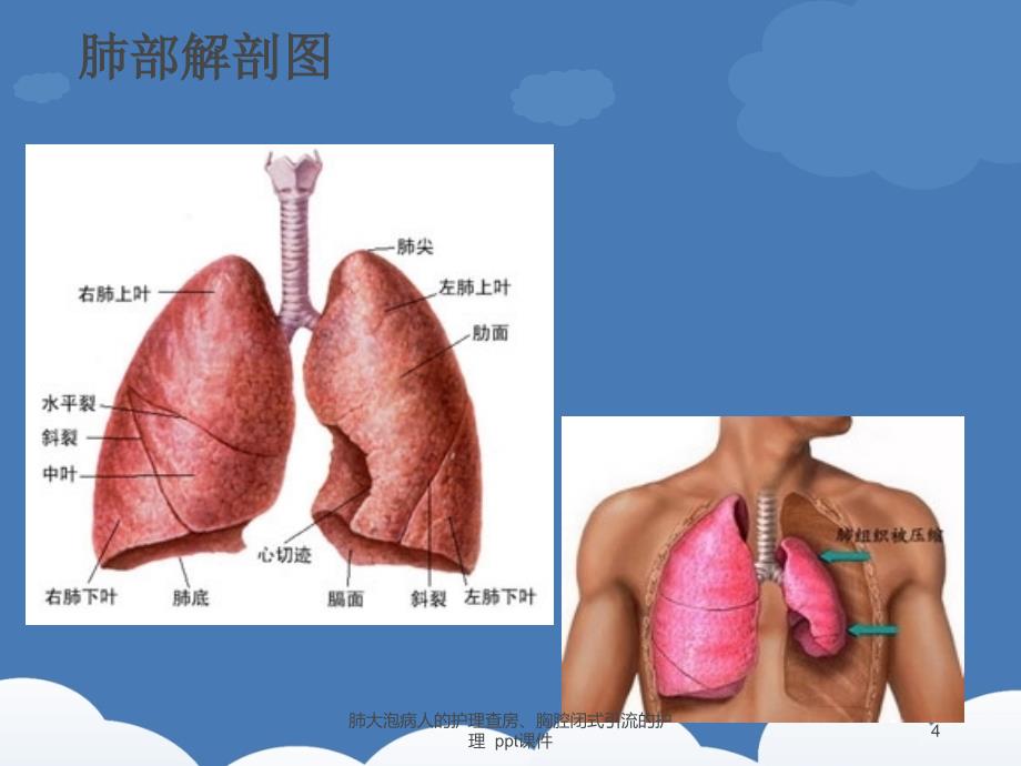 肺大泡病人的护理查房胸腔闭式引流的护理-ppt课课件_第4页