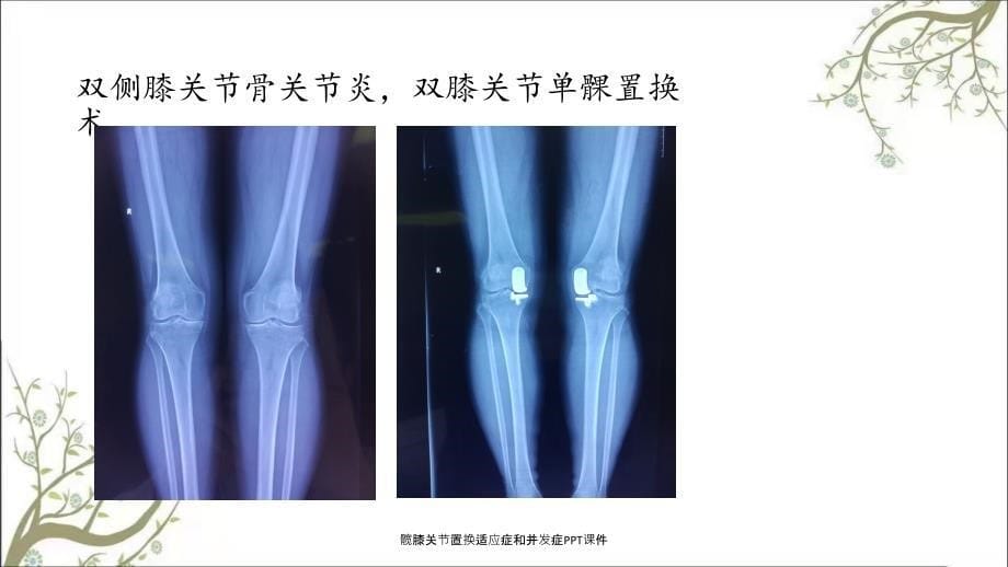 髋膝关节置换适应症和并发症PPT课件_第5页