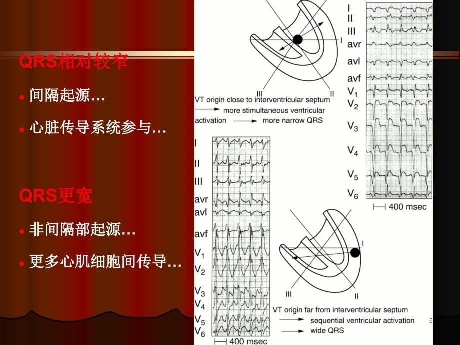 宽QRS心动过速的鉴别诊断_第5页