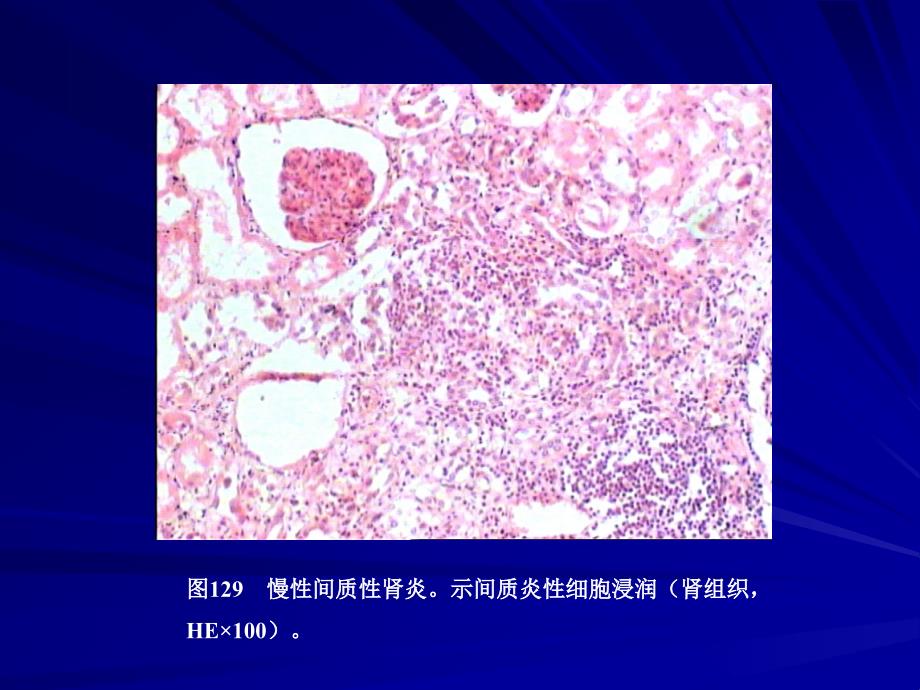 泌尿系统疾病猝死昆明医学院法医病理学精品课程_第4页