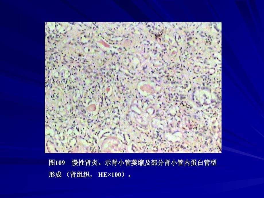 泌尿系统疾病猝死昆明医学院法医病理学精品课程_第5页