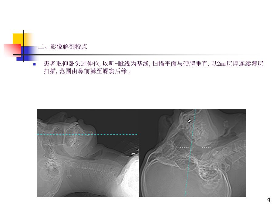 窦口鼻道复合体影像解剖及临床意义ppt课件_第4页