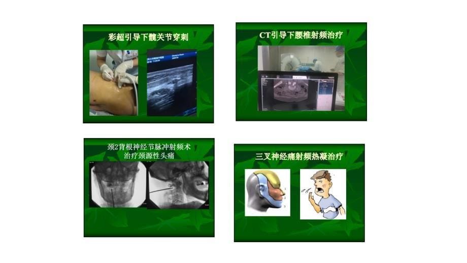 射频在疼痛中的应用_第5页