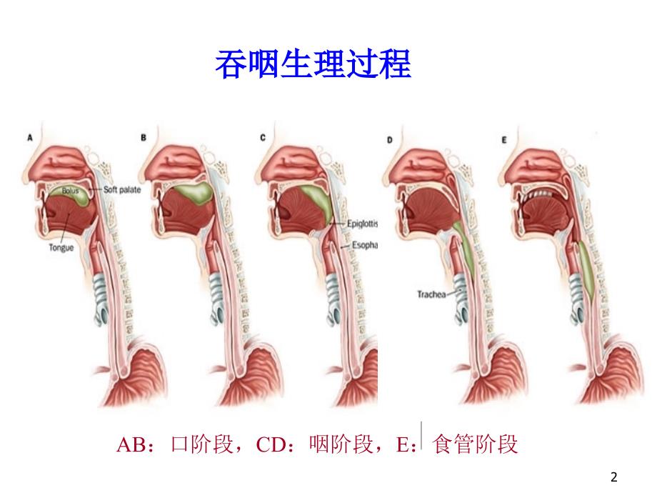 脑卒中后吞咽困难PPT_第2页