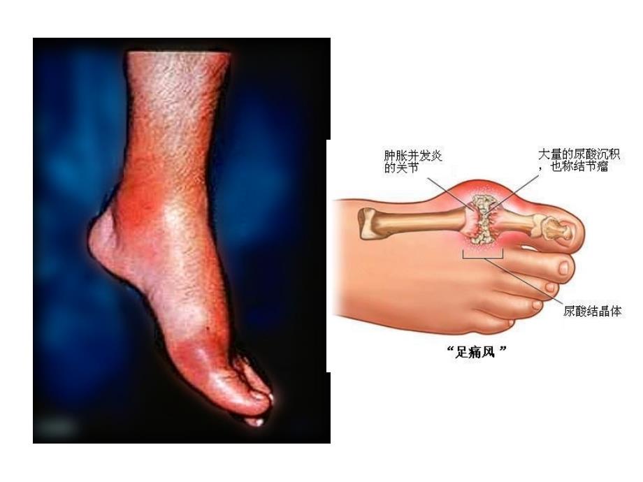 痛风病人的饮食指导.ppt_第3页