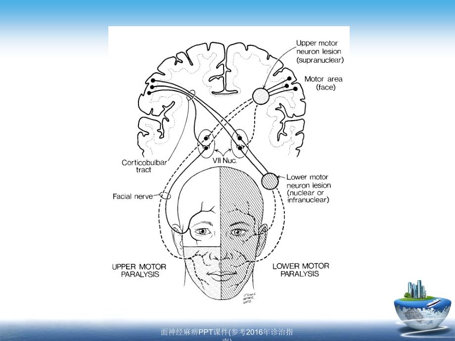面神经麻痹PPT课件(参考2016年诊治指南)_第3页