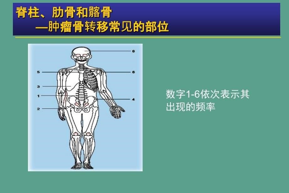 肿瘤骨转移金尔力ppt课件_第5页