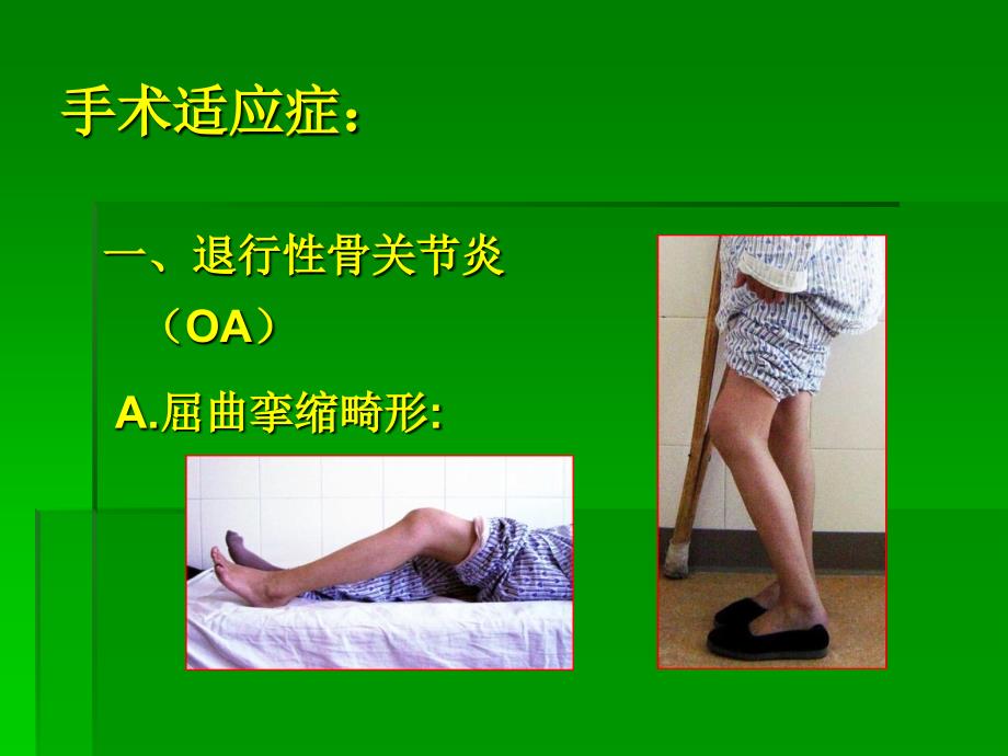 人工全膝关节置换要点.ppt_第3页