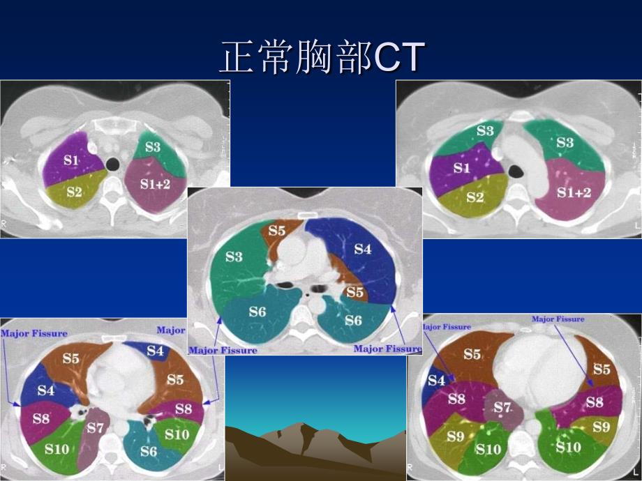 呼吸系统常见病典型胸部CT表现_第3页