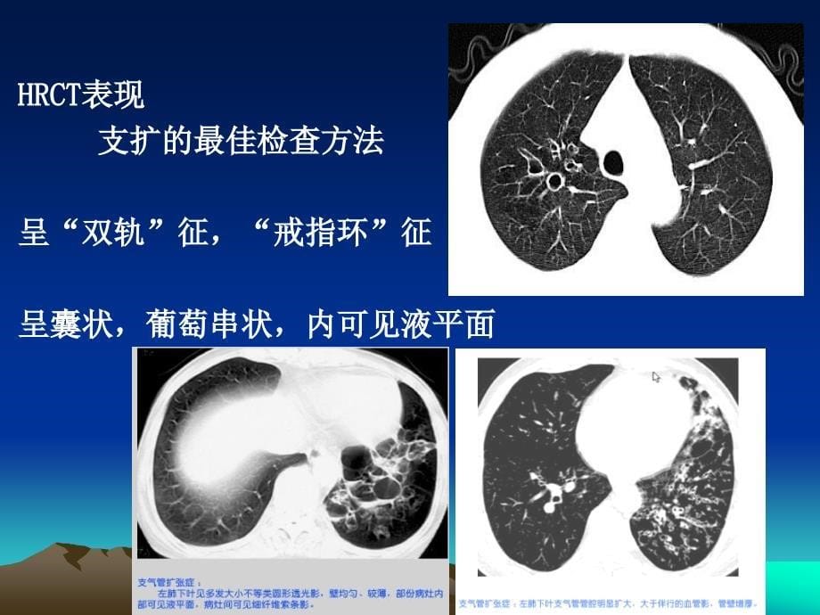 呼吸系统常见病典型胸部CT表现_第5页