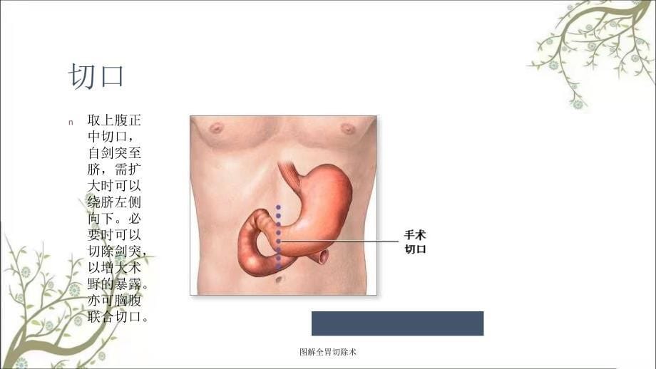 图解全胃切除术课件_第5页