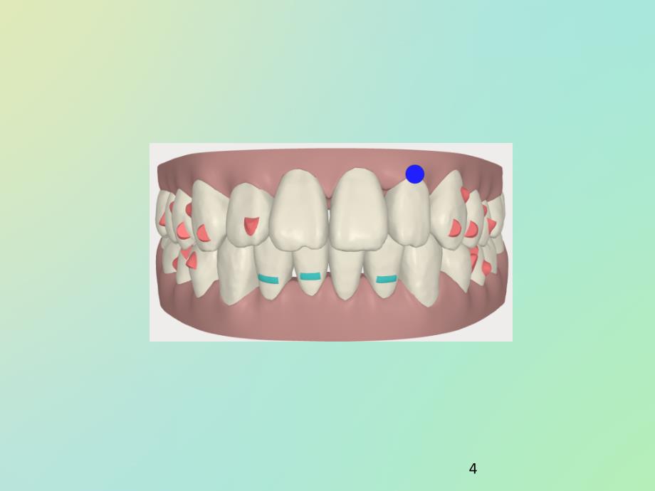 医学PPT课件隐形矫治的附件_第4页