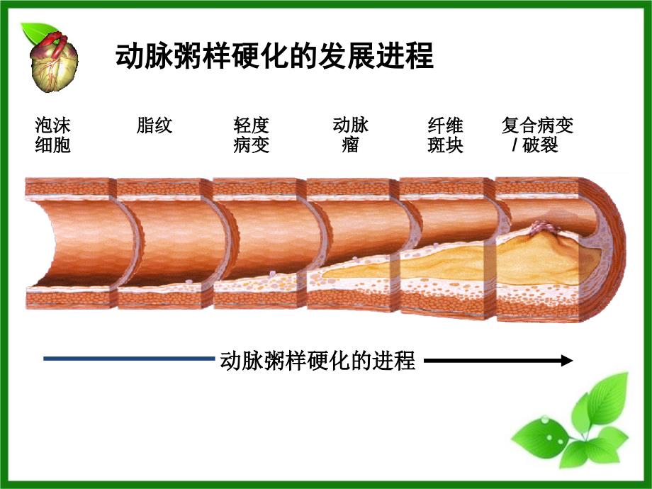 心肌梗死查房_第3页