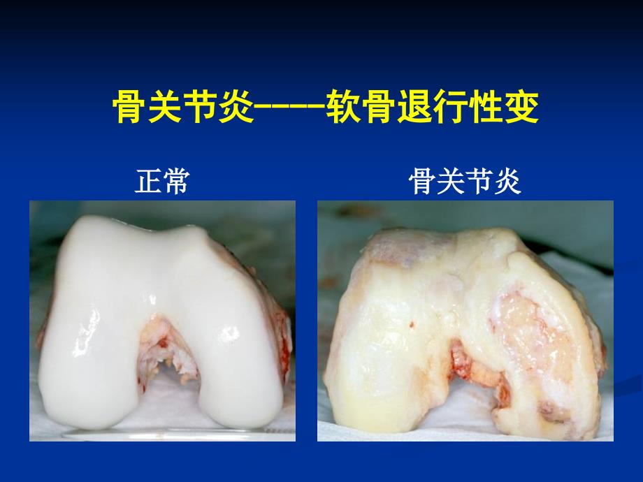 骨关节炎的药物治疗解放军总医院陈继营教授.ppt_第3页