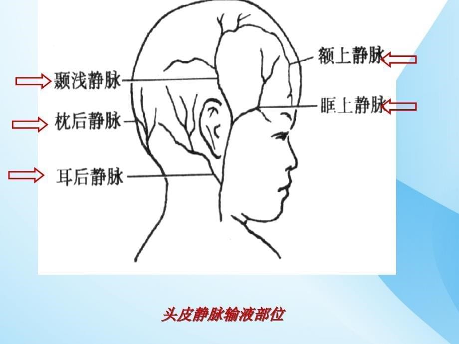 小儿头皮静脉穿刺技巧及特点_第5页