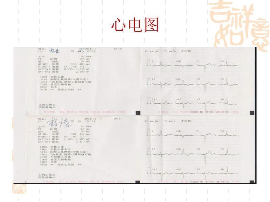 复杂病例经桡动脉介入治疗个案_第5页