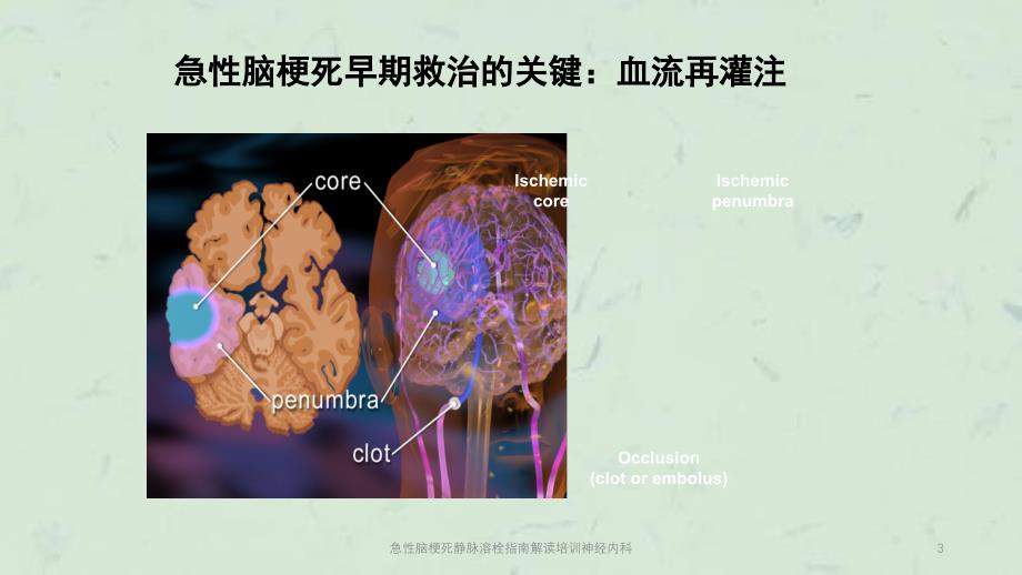 急性脑梗死静脉溶栓指南解读培训神经内科课件_第3页