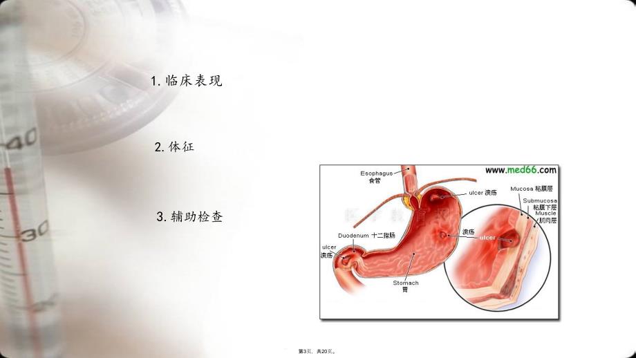 消化性溃疡的诊断与鉴别诊断(共20张)课件_第3页